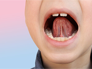 舌小帯短縮症の治療